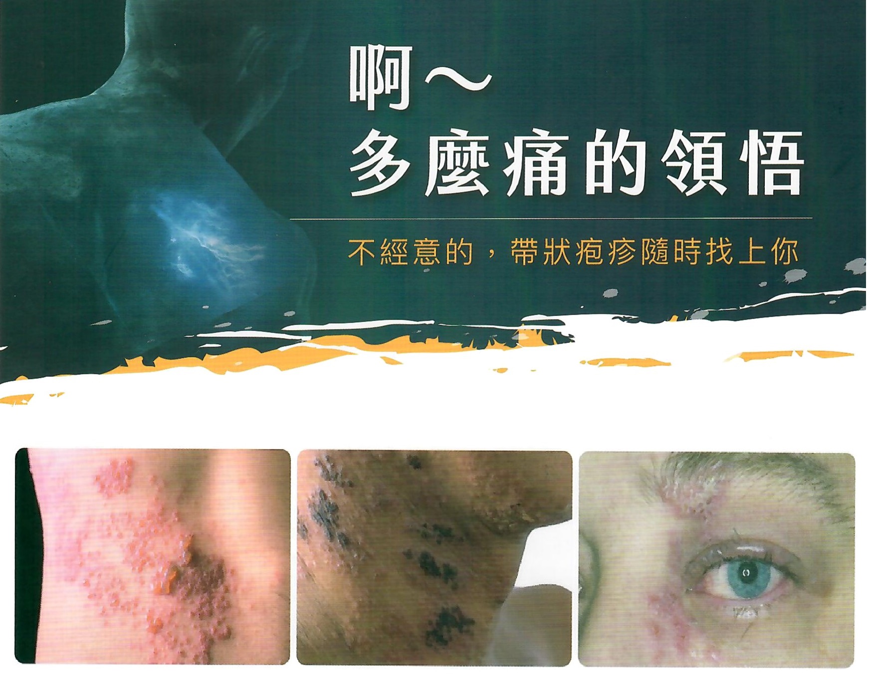 帶狀疱疹讓人痛😣快打疫苗來預防 – 樂田耳鼻喉科家醫科